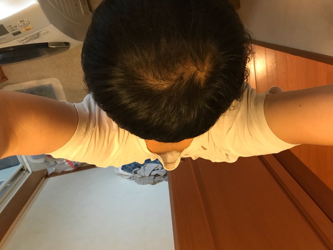 AGA ハゲ28日目 耐えられない初期脱毛 : AGA ハゲの発毛日記、本当 ...