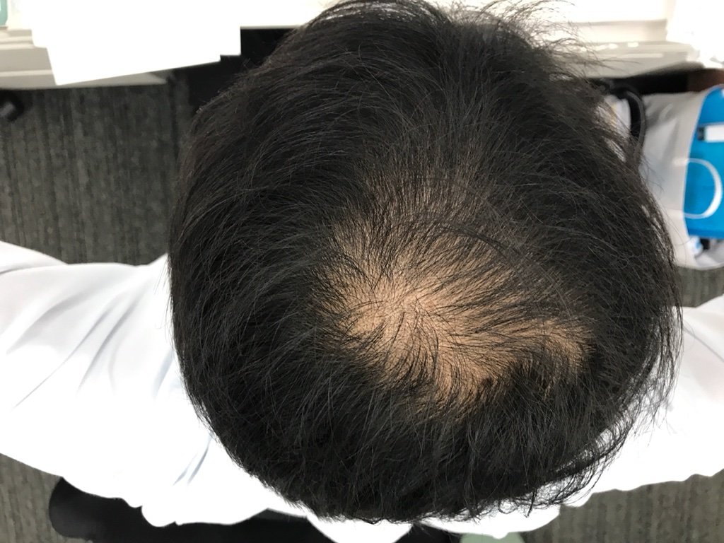 Aga ハゲ28日目 耐えられない初期脱毛 Aga ハゲの発毛日記 本当に生えるのか Aga Aga ハゲ28日目 耐えられない初期脱毛 Aga ハゲの発毛日記 本当に生えるのか Aga