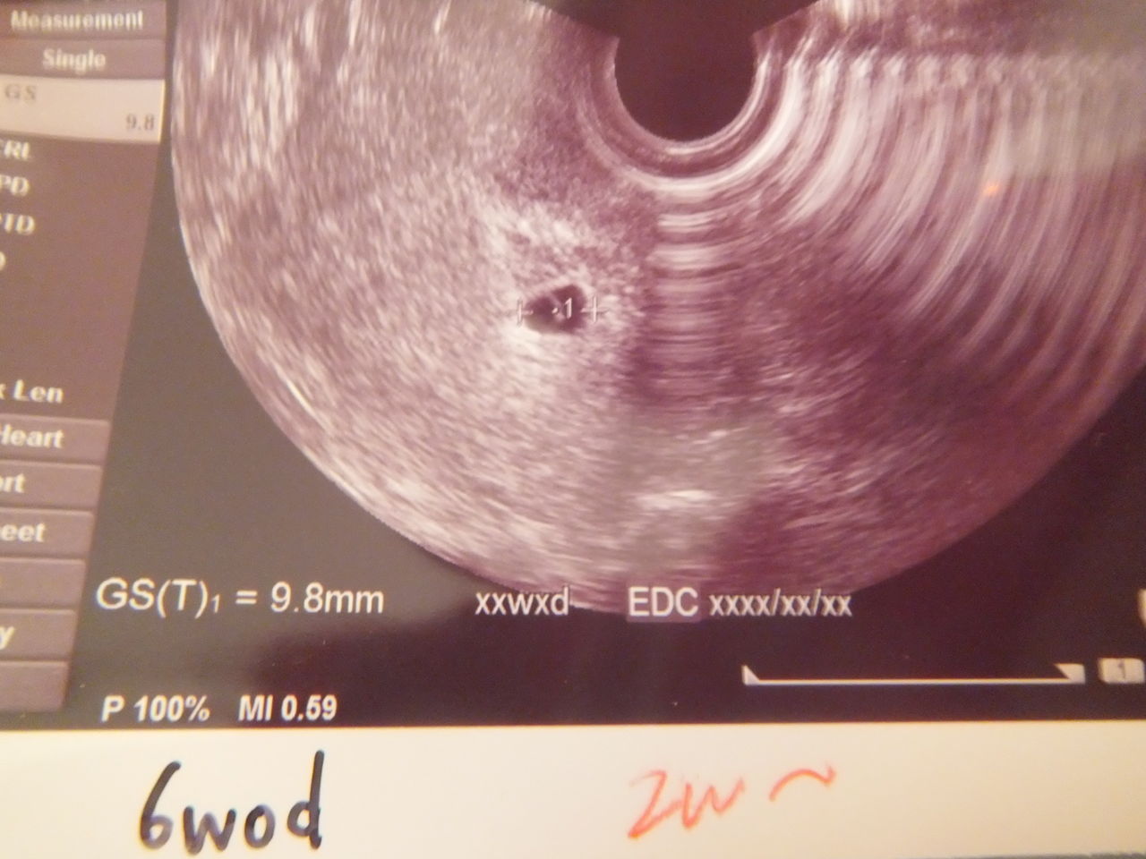 胎嚢 6 のみ 週