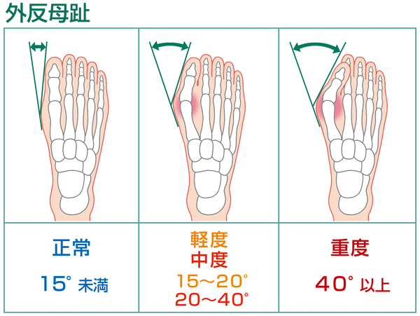 2019年03月21日 : 足とインソールのblog