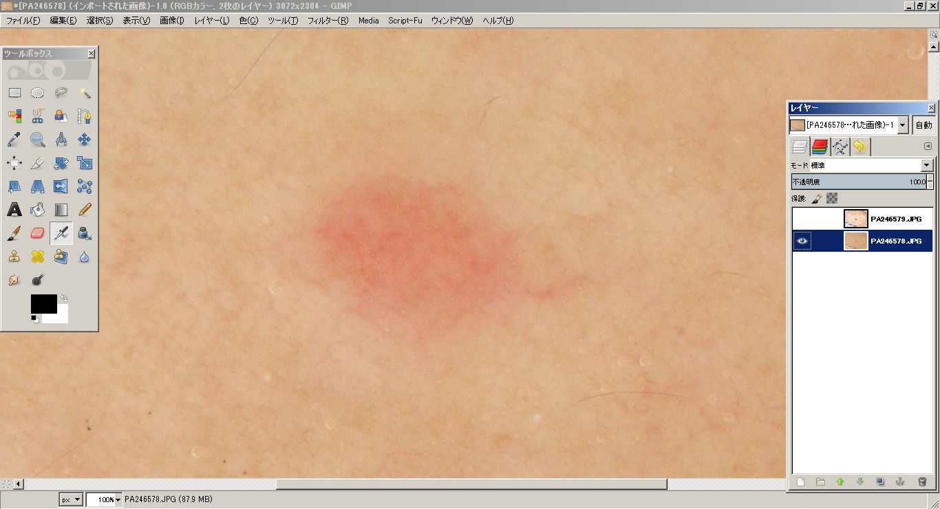 連写合成で処理画像のノイズを劇的に低減する フリーソフトでやるダーモスコピー写真の画像処理 ２０ フリーソフト でやるダーモスコピー写真の画像処理