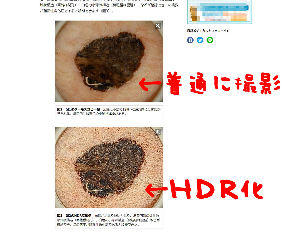 黒い病変は明るくして観察しよう ということで暗い画像を明るく調整してみようじゃないか フリーソフトでやるダーモスコピー写真の画像処理 付録６ フリーソフトでやるダーモスコピー写真の画像処理