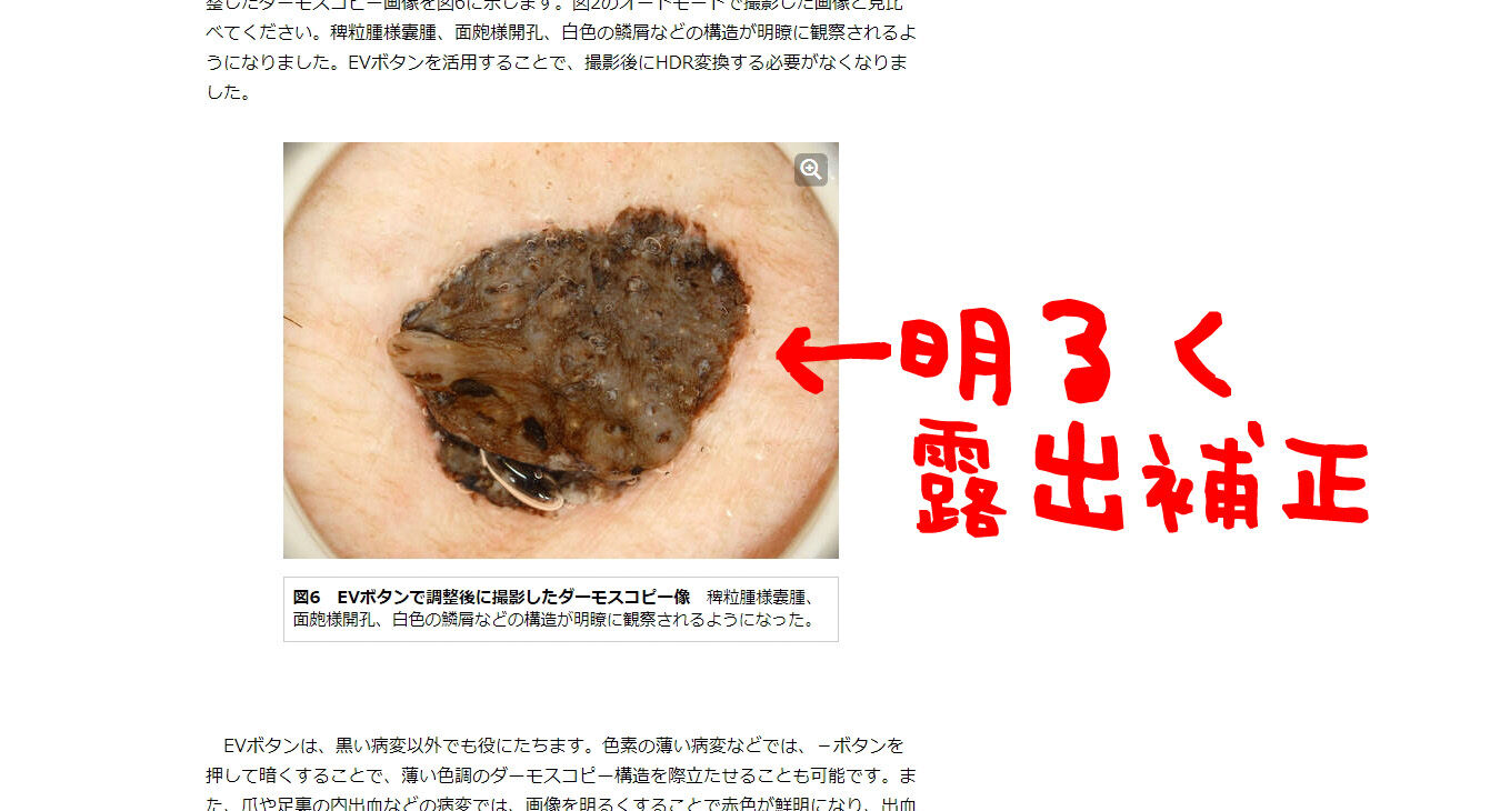 黒い病変は明るくして観察しよう ということで暗い画像を明るく調整してみようじゃないか フリーソフトでやるダーモスコピー写真の画像処理 付録６ フリーソフトでやるダーモスコピー写真の画像処理