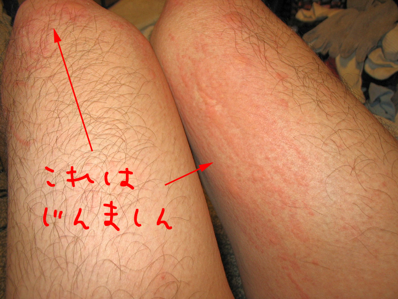 ブヨに刺された跡 しこり