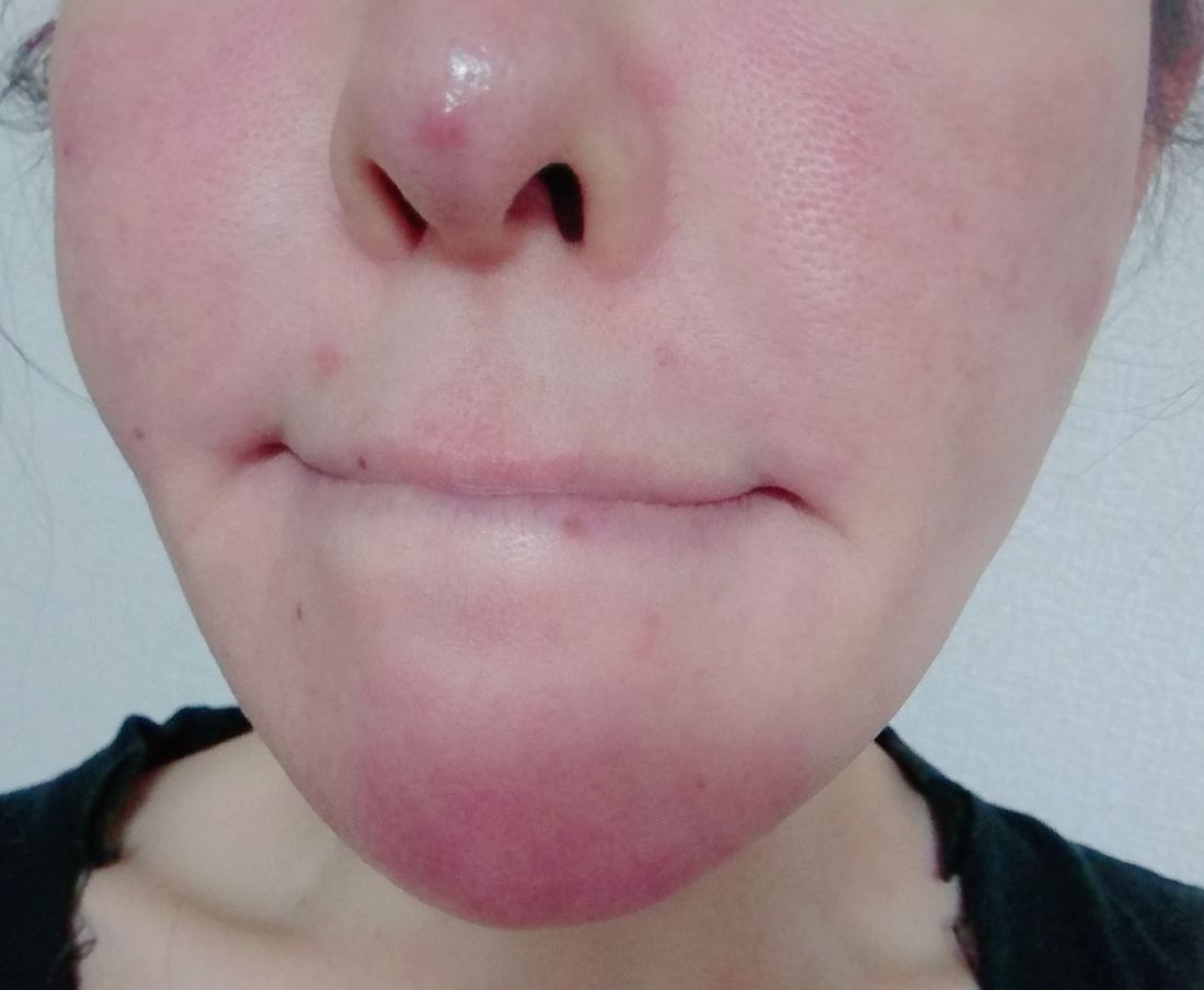 アラフォー美容オタクの目指せ 美魔女ブログ 鼻に出来物 皮膚科の薬が効かなくて困る アラフォー美容オタクの目指せ 美魔女ブログ 鼻に出来物 皮膚科の薬が効かなくて困る