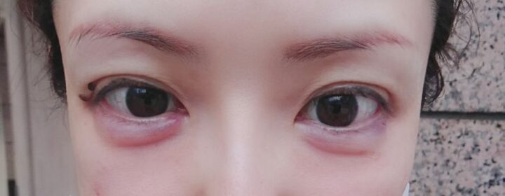 アラフォー美容オタクの目指せ 美魔女ブログ 涙袋 施術1日目 アラフォー美容オタクの目指せ 美魔女ブログ 涙袋 施術1日目