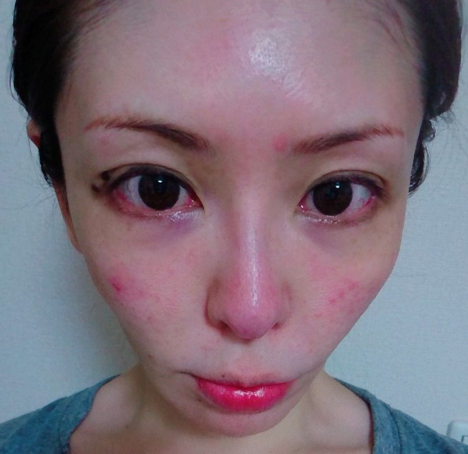 アラフォー美容オタクの目指せ 美魔女ブログ また肌荒れで皮膚科へ ビタミン注射をしてもらいました アラフォー美容オタクの目指せ 美魔女ブログ また肌荒れで皮膚科へ ビタミン注射をしてもらいました