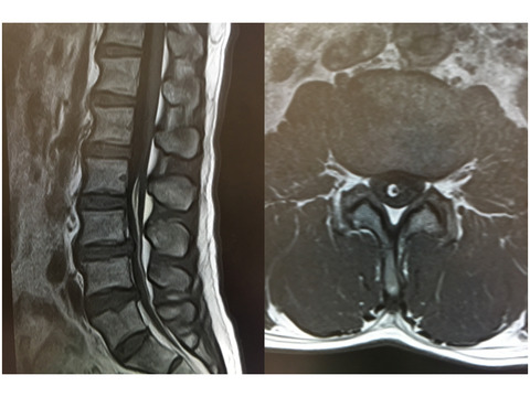 まれな腰椎疾患③緊張性脊髄終糸症、脊髄終糸症候群について