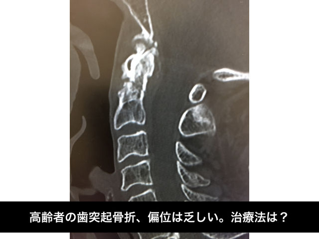 高齢者の歯突起骨折の治療について とぜんな脊椎外科医のブログ