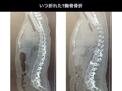 腹臥位？体位交換？いつ起きた、胸骨骨折