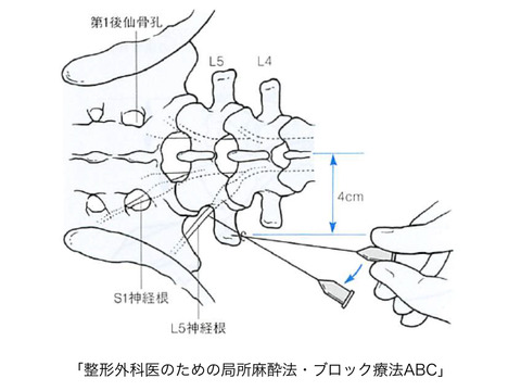 アンギオ室での神経根ブロックの手技