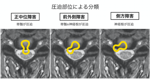 椎間板ヘルニアと診断された方へ