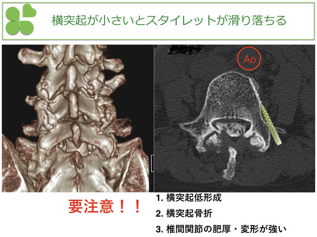 バイパープライムのスタイレットのピットフォール 関西弁さんご提供 とぜんな脊椎外科医のブログ