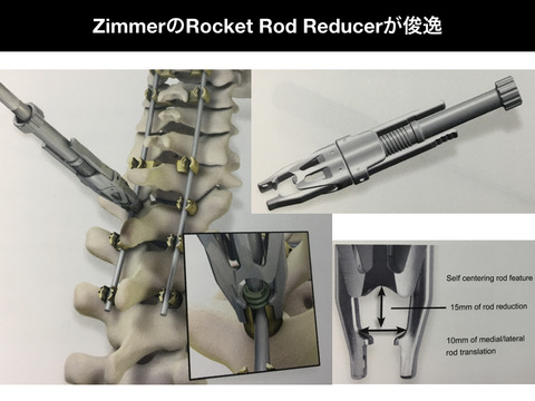 頸椎後方固定のロッドリデューサー、ZimmerのRocket Rod Reducerが俊逸。