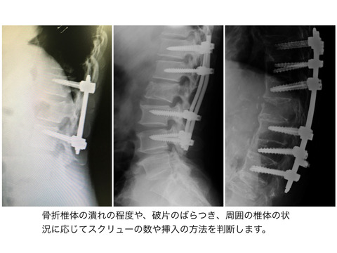 胸腰椎破裂骨折の手術治療の方法には正解がない！！