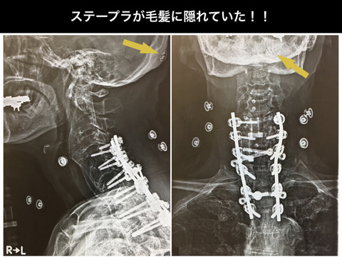 頭部でステープラー処置があったことはお願いだから、きちんと申し送ってね