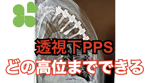 続・透視下経皮的椎弓根スクリューはどの高位まで挿入できる？