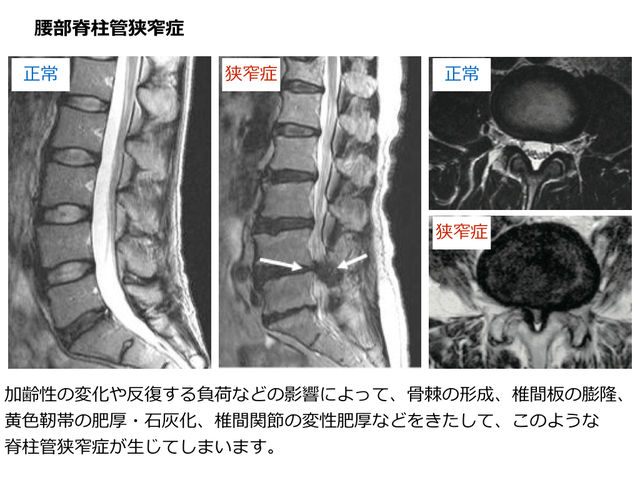 症 が た なっ すべり 腰椎 楽に