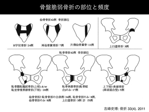 見逃しがちな脆弱性骨盤骨折について