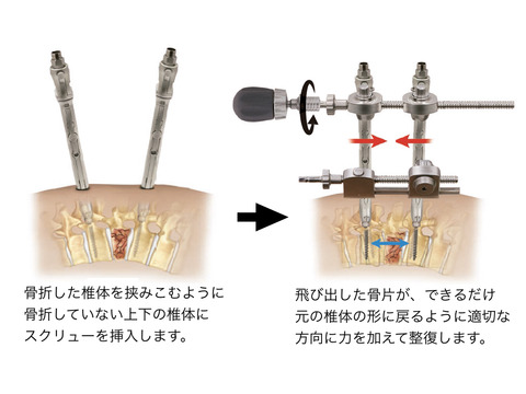 低侵襲法による脊椎後側方制動術について