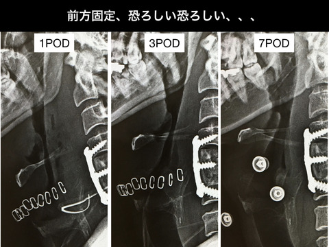 やっぱり頸椎前方固定は怖い。