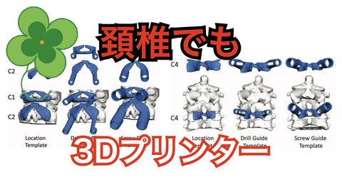 頚椎後方固定での3D患者適合型ドリルガイドSGTについて