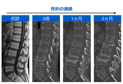 骨粗鬆症性椎体骨折の負の連鎖