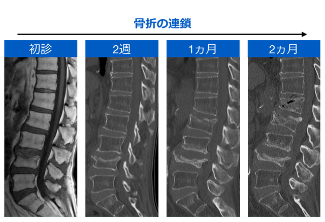 その他の脊柱疾患 とぜんな脊椎外科医のブログ
