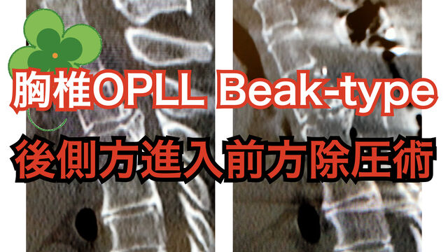 胸椎後縦靭帯骨化症 とぜんな脊椎外科医のブログ 胸椎後縦靭帯骨化症 とぜんな脊椎外科医のブログ