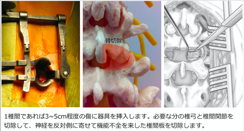 低侵襲腰椎後方椎体間固定術（MIS-T(P)LIF）を受ける方へ