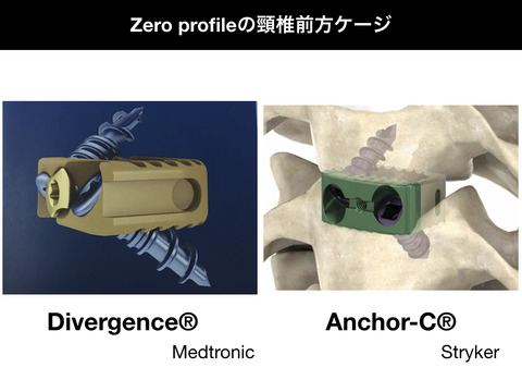 アンカーC、ゼロプロファイルの頸椎前方ケージ
