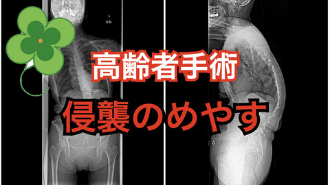 高齢者の手術を安全に行うための侵襲の目安