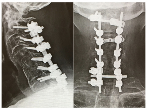 頸椎後方固定のスクリューヘッドの配列・ロッド締結は術前の検討がすべて