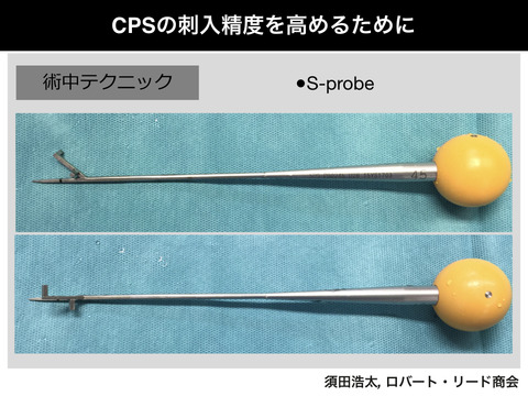 頚椎椎弓根スクリューの精度を高めるSプローブ！！