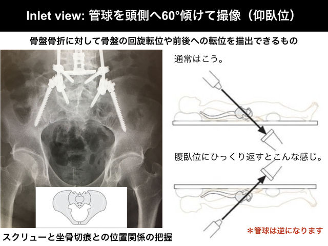 Inlet Viewとoutlet Viewのまとめ とぜんな脊椎外科医のブログ