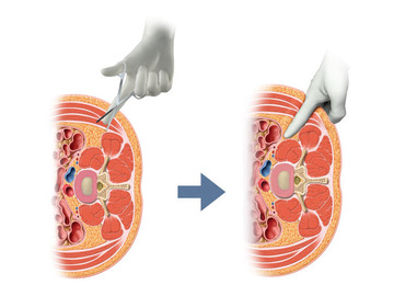 XLIFの後腹膜腔アプローチの理解のために。後傍腎腔？