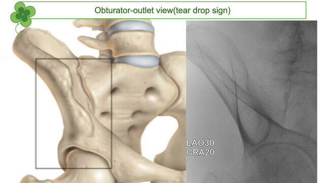 腸骨スクリュー入れるときのセッティング とぜんな脊椎外科医のブログ