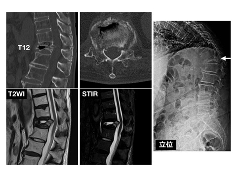 胸腰椎損傷は後方要素損傷を見逃さない！