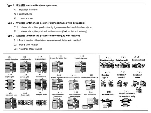 胸腰椎損傷　新AO分類についてのまとめ