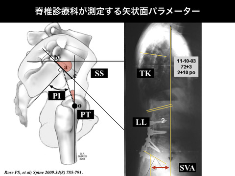 脊椎の矢状面バランスの測定パラメーターについて