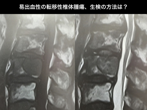 易出血性の転移性椎体腫瘍の生検の方法