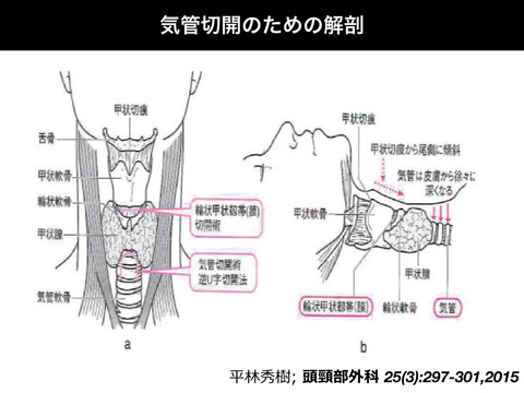 気管切開術の恐怖について