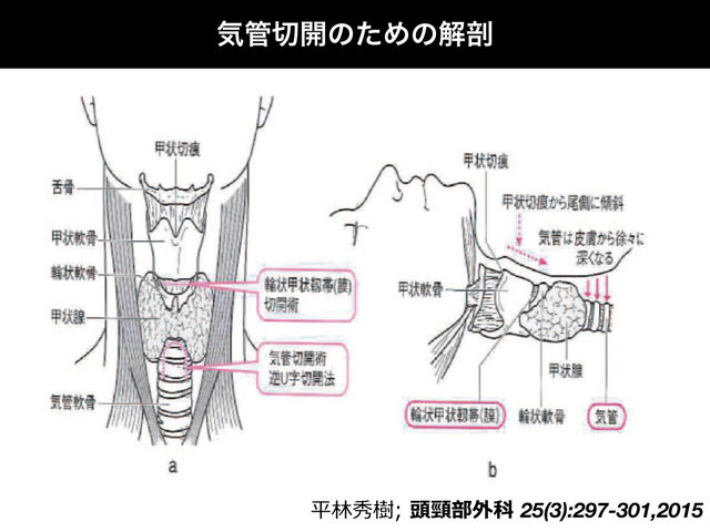 気管切開術の恐怖について とぜんな脊椎外科医のブログ