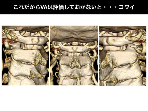 これだから椎骨動脈は評価しておかないと・・・