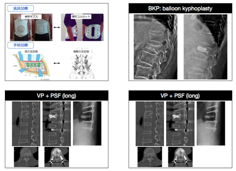 新人Nsむけ勉強会②骨粗鬆症性椎体骨折の治療法