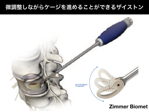 Zimmerのブーメランケージ、ザイストン、俊逸でした。