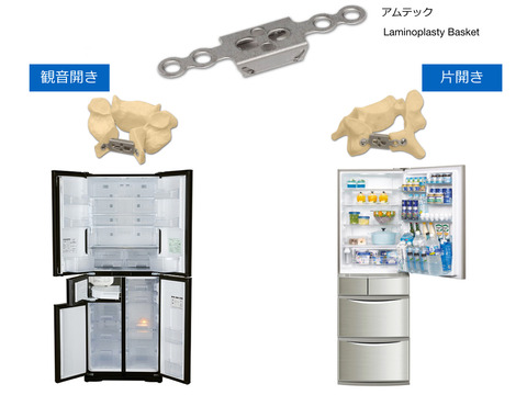 最近の頚椎椎弓形成術はチタンプレートに落ち着く