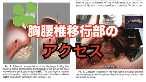 胸腰椎移行部へのアクセス。lateral extracoelomic (retropleural/retroperitoneal) approachについて