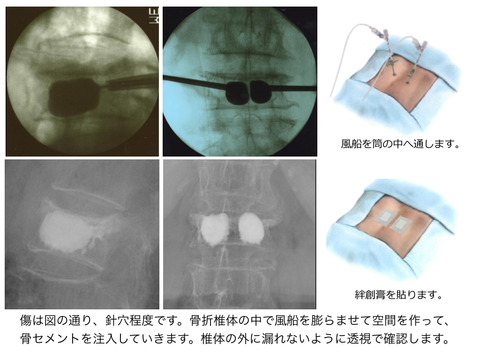 骨粗鬆症性椎体骨折の初期画像での予後予測について