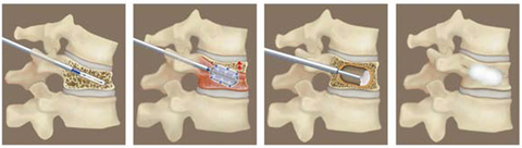 経皮的バルーン椎体後弯矯正術：BKP(balloon kyphoplasty)を受ける方へ